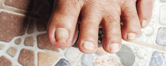 巻き爪の治し方